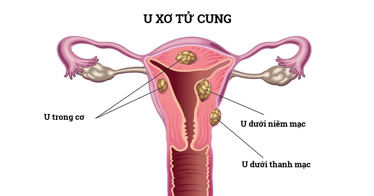 u xơ tử cung là dạng khối u lành tính trong lớp cơ tử cung