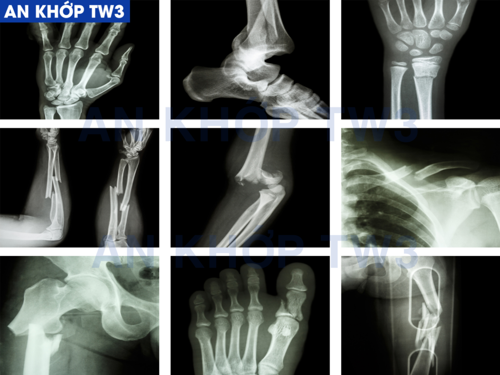 Đau nhức xương khớp có thể xảy ra ở nhiều vị trí như tay, chân, cột sống, vai, lưng, gối